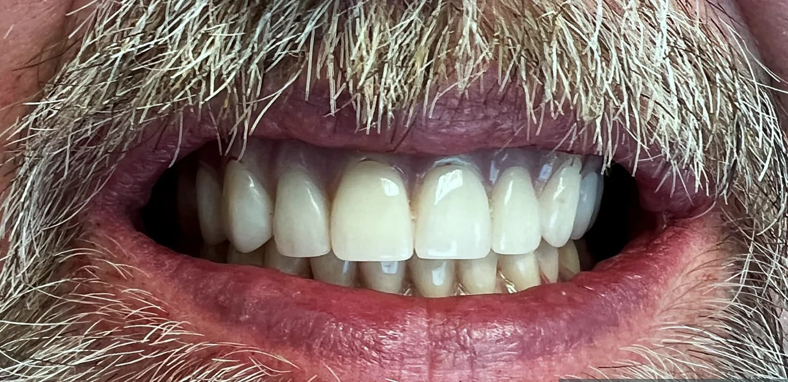 Case 03, after