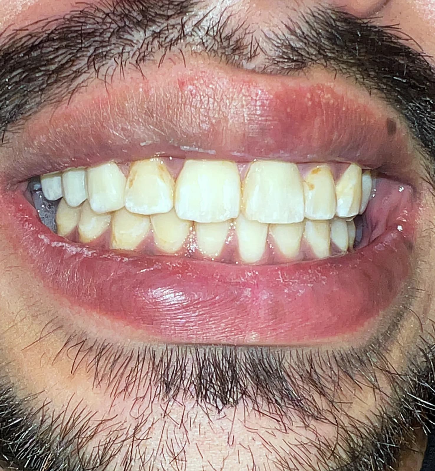 Case 06, after