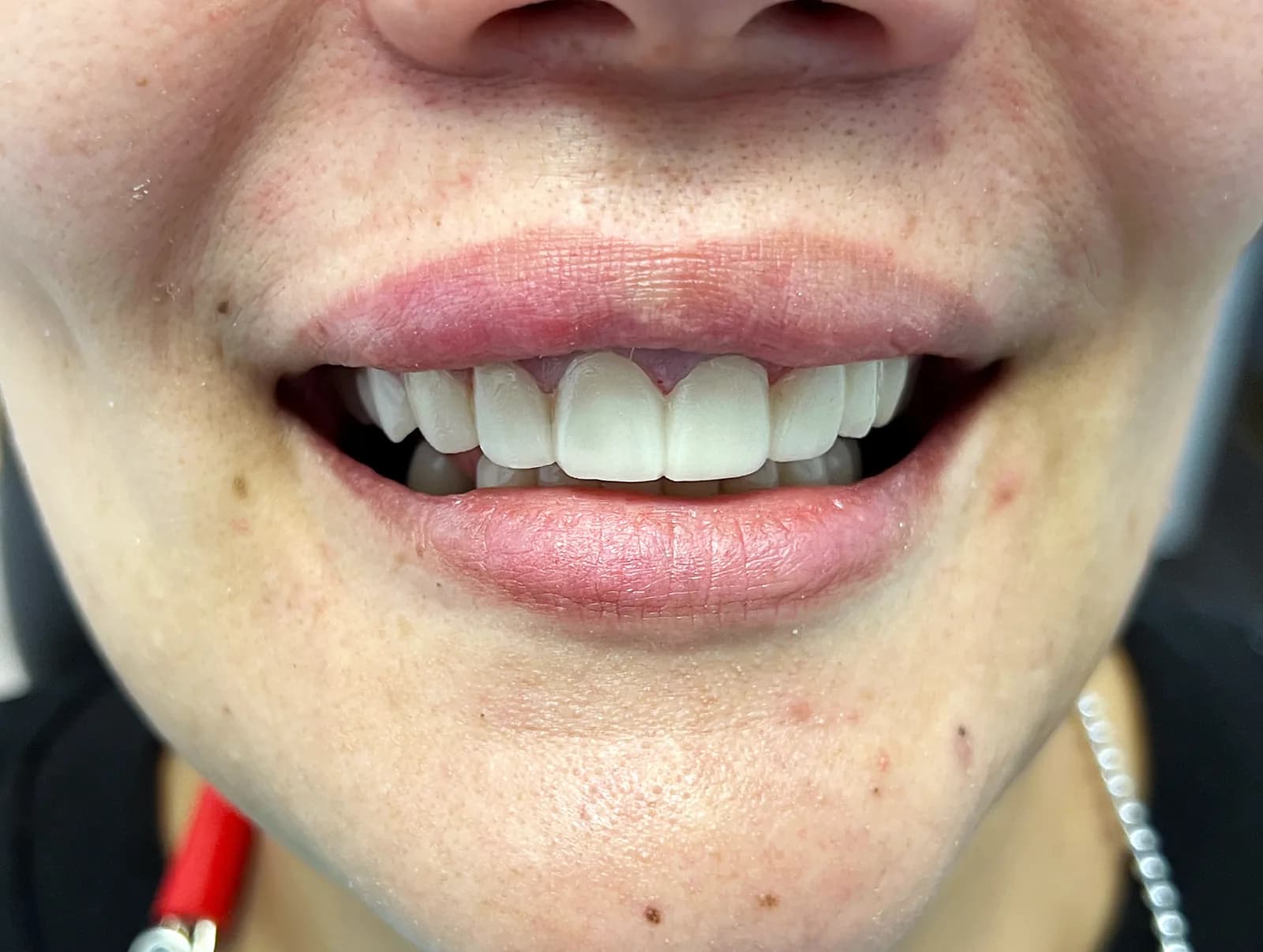 Case 09, after