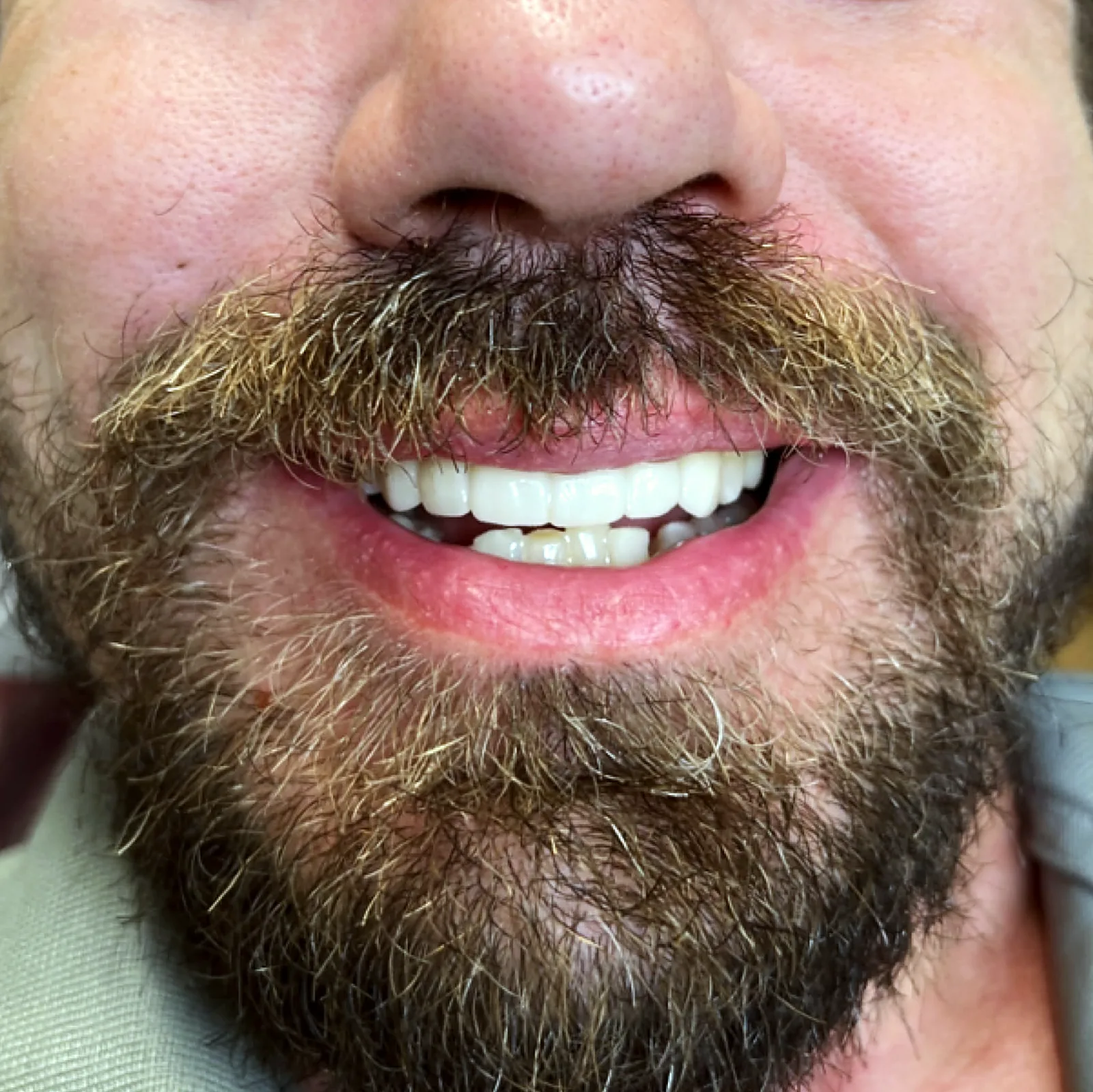 Case 13, after