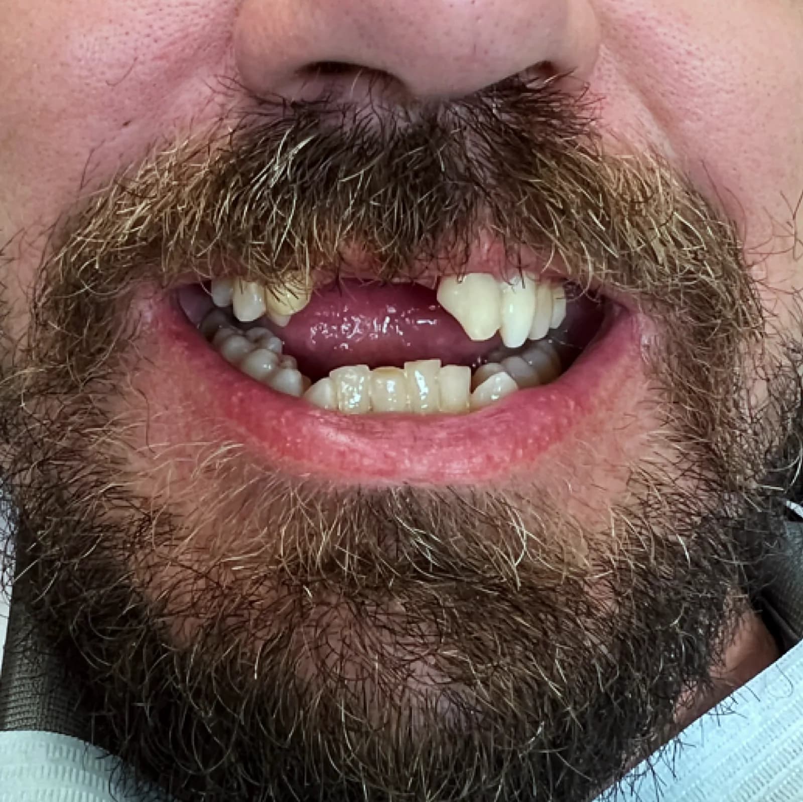 Case 13, before