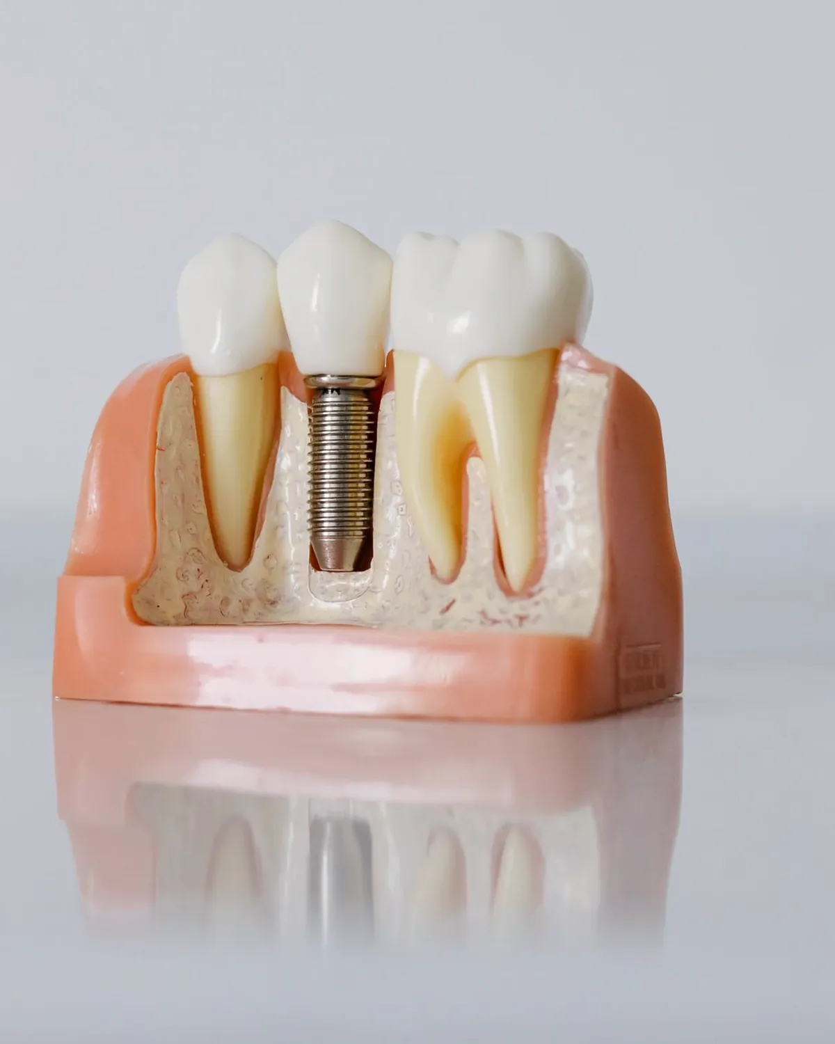 A dental model showing an implant screw between natural teeth