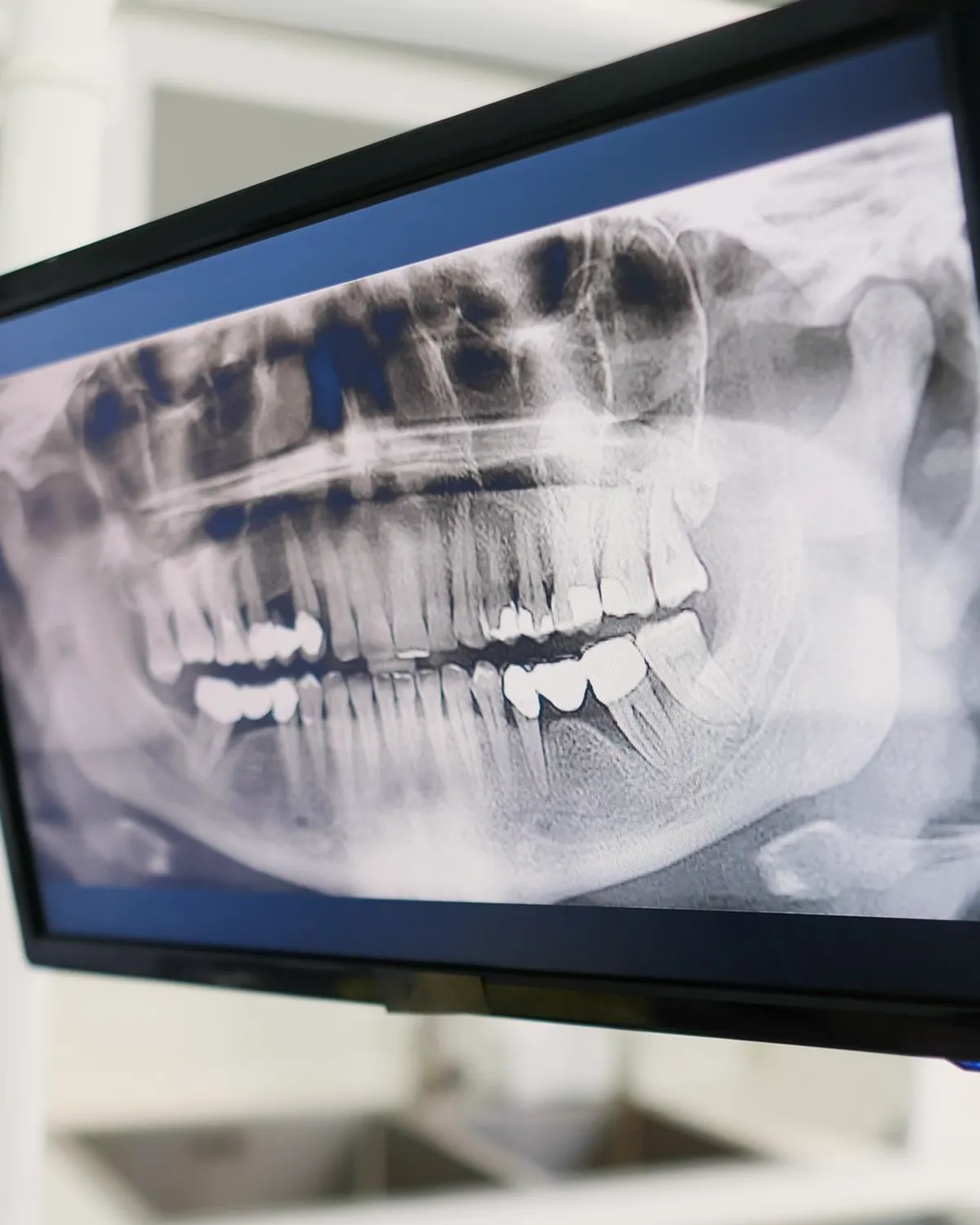 A panoramic dental x-ray shown on a clinic monitor